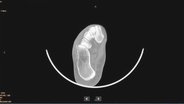 跟骨解剖与跟骨骨折CT分型