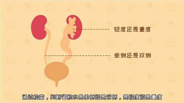 如何诊断小儿肾积水?如何找出肾积水的原因?