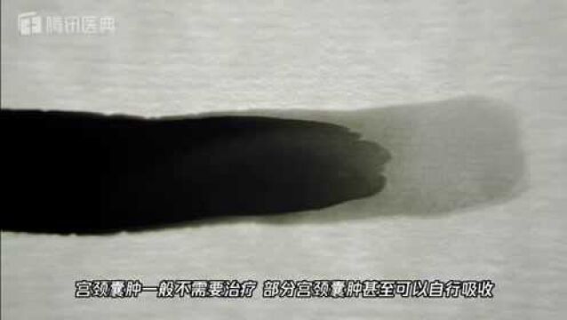 宫颈囊肿、纳什囊肿严重吗?医生:别太紧张,很多时候不用治