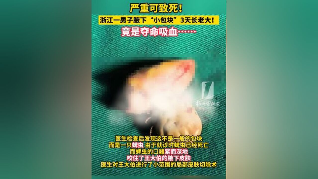 严重可致死!浙江一男子腋下“小包块”3天长老大!竟是夺命吸血……万万没想到