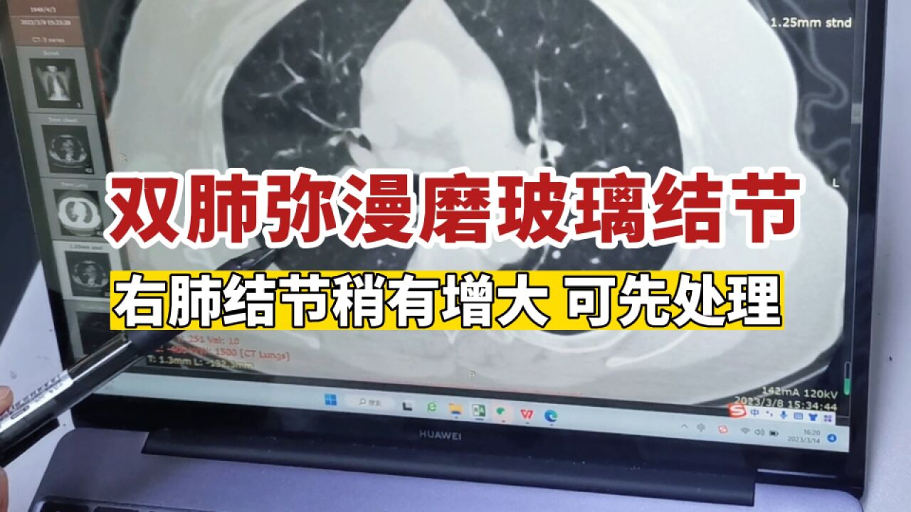 双肺弥漫磨玻璃结节,右肺1年时间稍有增大,可以先手术处理