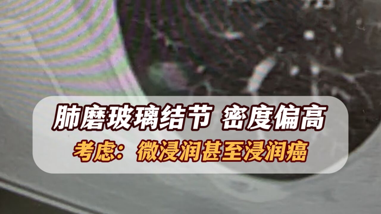 这样的磨玻璃结节,考虑是微浸润甚至浸润癌!下决心手术吧