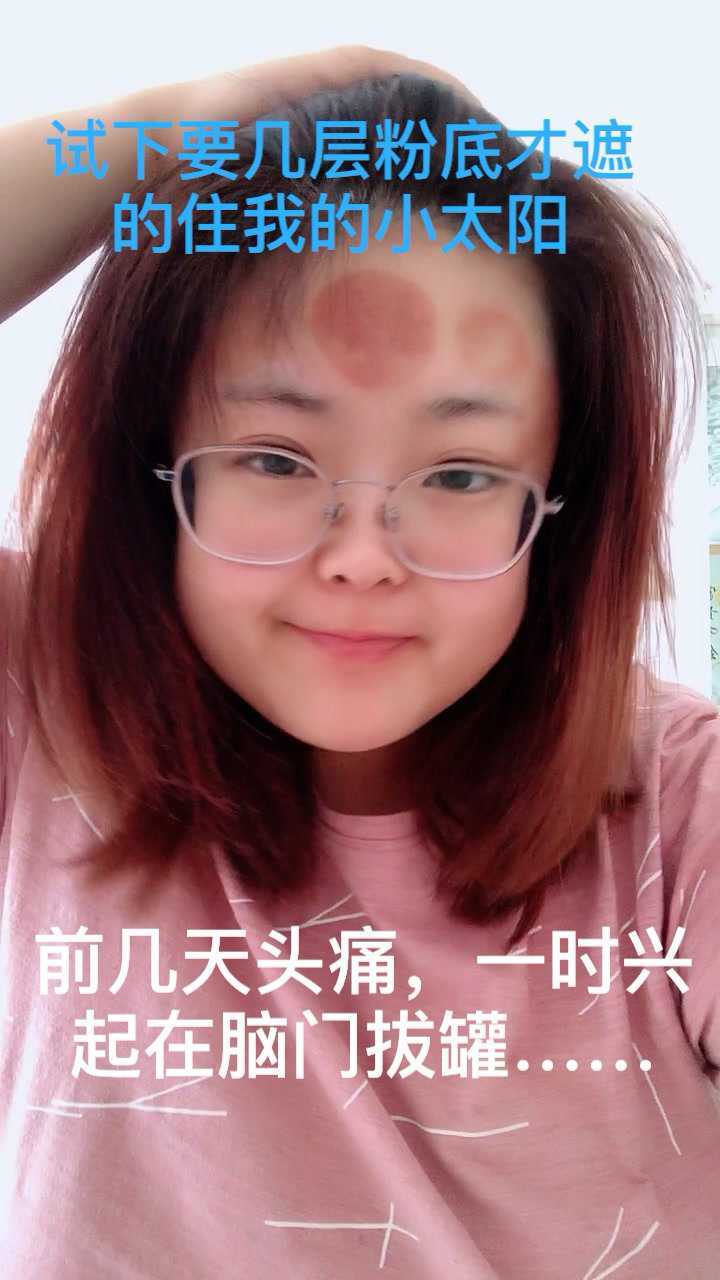 劝大家不要在脑门拔罐…不然
