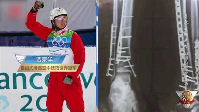 贾宗洋备战平昌冬奥会曾受伤 左腿打了22根钢钉 X光照片让人泪目