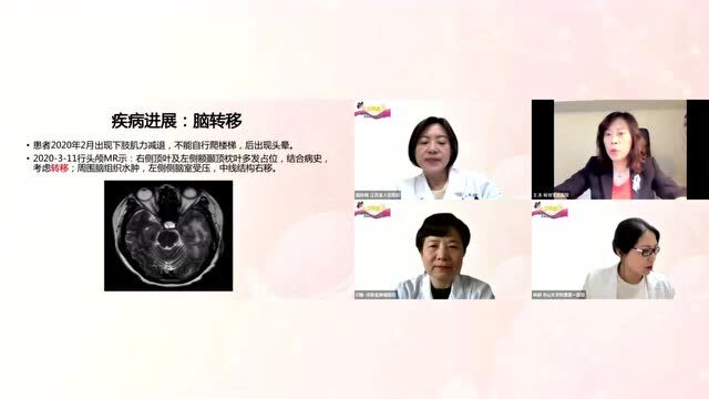 乳腺圆桌派第二季丨第一期:大咖云诊疗—乳腺癌脑转移患者的治疗该何去何从?