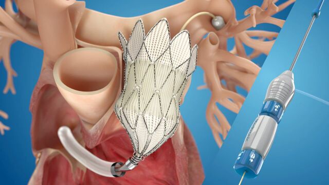 美敦力 Harmony 介入肺动脉瓣置换