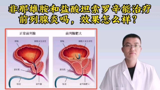 非那雄胺和盐酸坦索罗辛能治疗前列腺炎吗?效果怎么样?