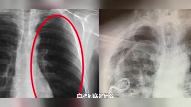 重症白肺死亡率或达40%以上!白肺到底有多可怕?家有老人必看!