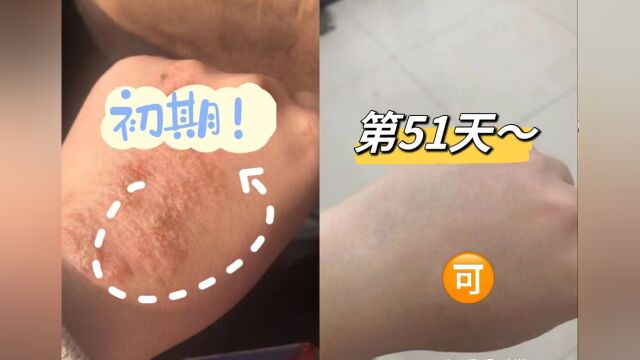 瘙痒怎么也止不住?教你两个月快速止痒法,再顽固的湿疹也能去除!