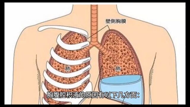 胸腹腔积液有哪些原因