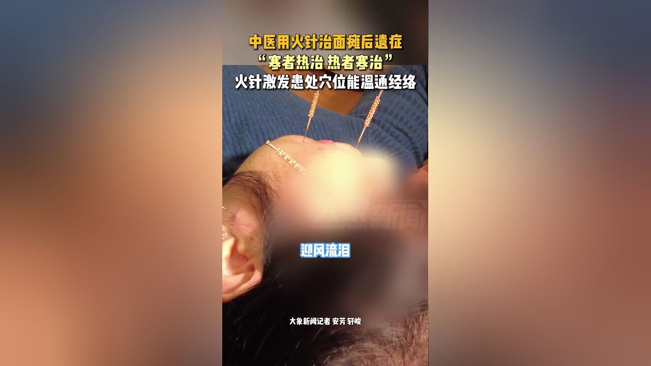 中医用火针治面瘫后遗症,“寒者热治 热者寒治”