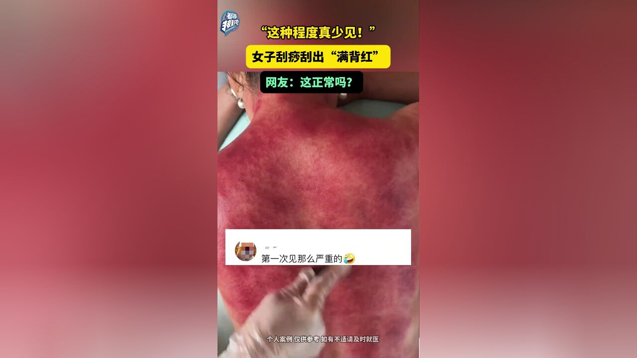 女子刮痧刮出“满背红”网友:这正常吗?