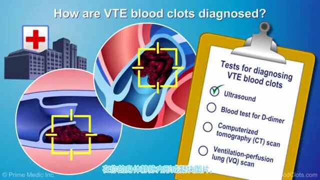 静脉血栓栓塞症VTE的形成和诊断动画演示