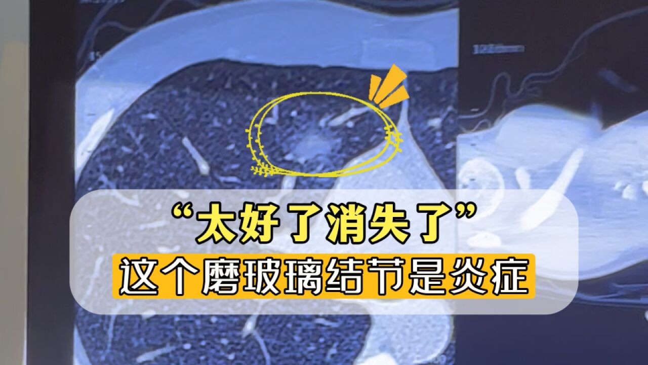 太好了消失了!29岁小伙查出磨玻璃结节,随访后消失