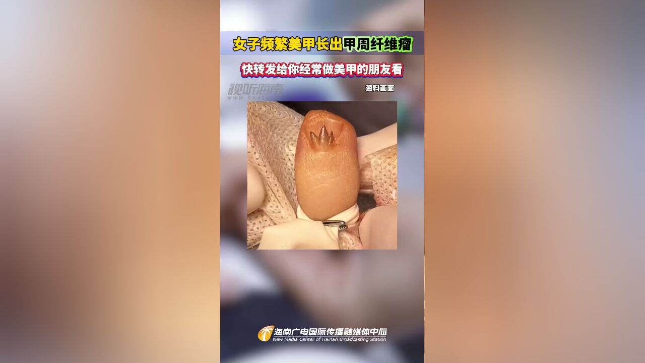 女子频繁美甲长出甲周纤维瘤