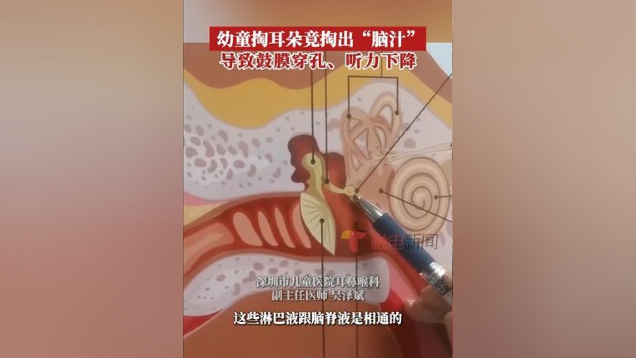 近日,广东深圳,1岁半的豆豆趁着家人没注意,学爸爸掏耳朵,不慎将棉签捅进耳道深处流血,妈妈发现后,立即将棉签拔出,孩子的耳...