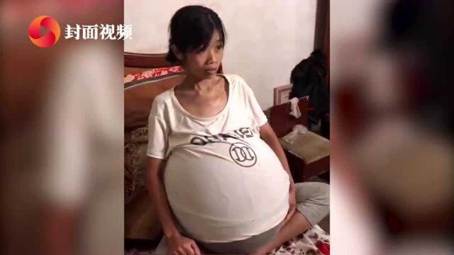 贵州女子身患怪病肚子大如巨球 腹腔积液达5000毫升始终查不出病因