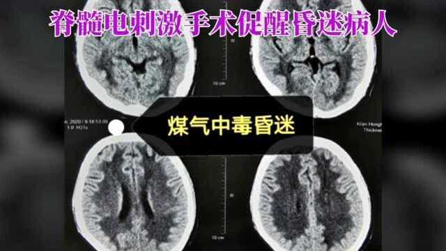 脊髓电刺激手术促醒煤气中毒患者