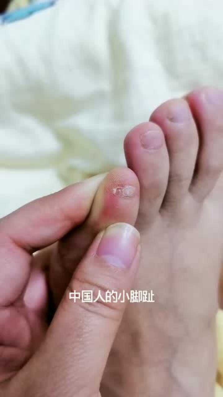 你知道为什么有的人小拇指指甲是两瓣的吗