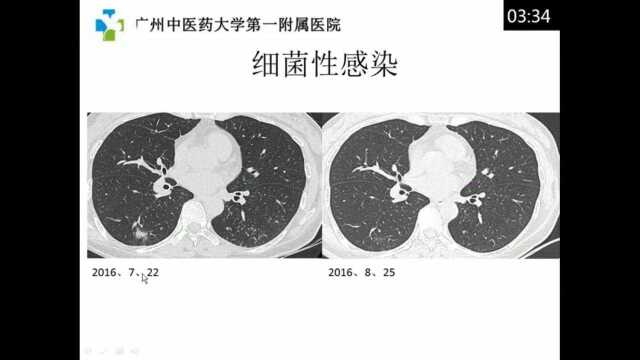 病毒性肺炎影像诊断与鉴别诊断广州中医院大学第一附属医院郑芸