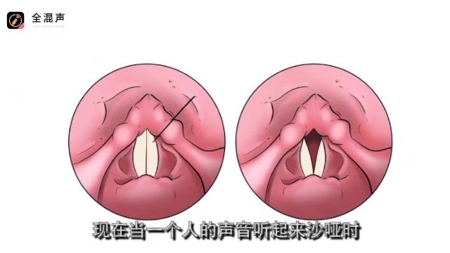 嗓音“杀手”声带小结是如何形成的?全混声伍文彬老师