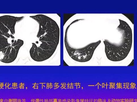 不同类型肺部真菌病CT诊断与鉴别首都医科大学北京世纪坛医院王仁贵