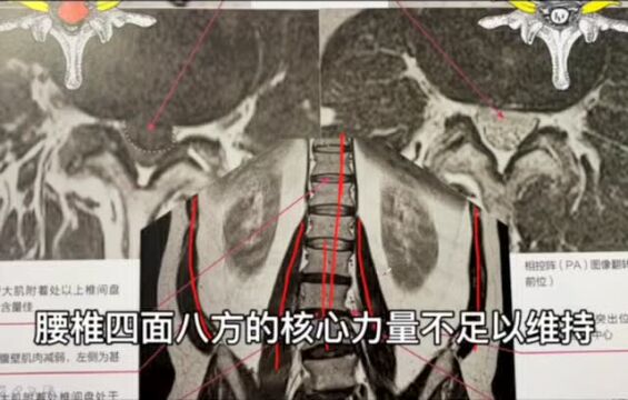 腰间盘突出案例分享和动作讲解