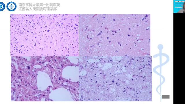 【第三期精彩回放】2022中枢神经系统临床病理诊断实践线上系列研讨会