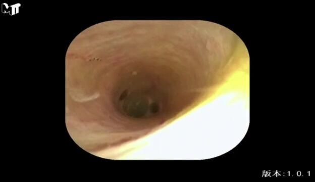 大外科31‖带你了解一种新型的胆道镜