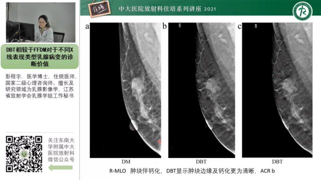 DBT相较于FFDM对于不同X线表现类型乳腺病变的诊断价值中大彭程宇