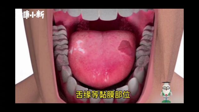 【科普视频】口腔溃疡怎么办?