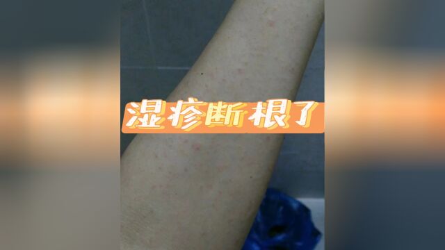 浑身瘙痒起疹子?过来人无偿分享最佳自愈经验,湿疹1招就去根!