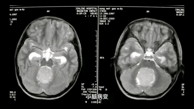 小脑病变以意向性震颤为特点……南京桃清堂中医