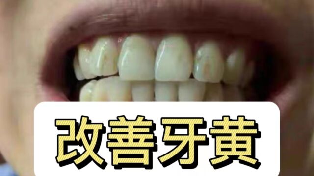 牙黄的朋友认真看!学会这几招,一个月重获洁白耀眼大白牙!