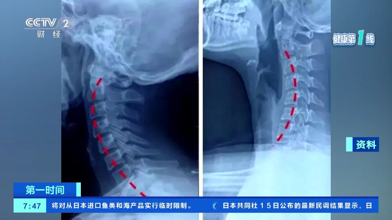 青年人患颈椎病呈高发趋势 慢性疼痛疾病要警惕