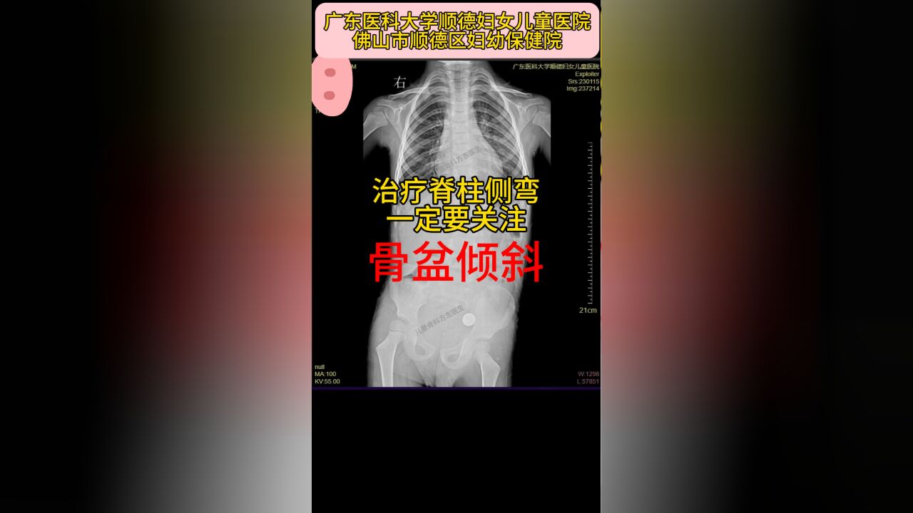 治疗脊柱侧弯,一定要关注骨盆倾斜: 1.骨盆是脊柱的“基座”,如果骨盆倾斜,一定会导致脊柱侧弯的发生和进展, 2.将骨盆恢复水平