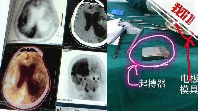 贵州一位“植物人”患者昏迷5个月后被成功“电”醒