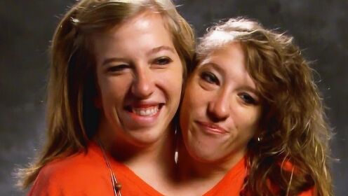 双头人是真的存在，姐妹两个共用一个身体，曾被医生断言活不下来 - 腾讯视频