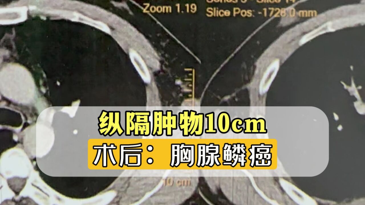 纵隔查出肿物10cm,术后胸腺鳞癌!治疗效果好不好?