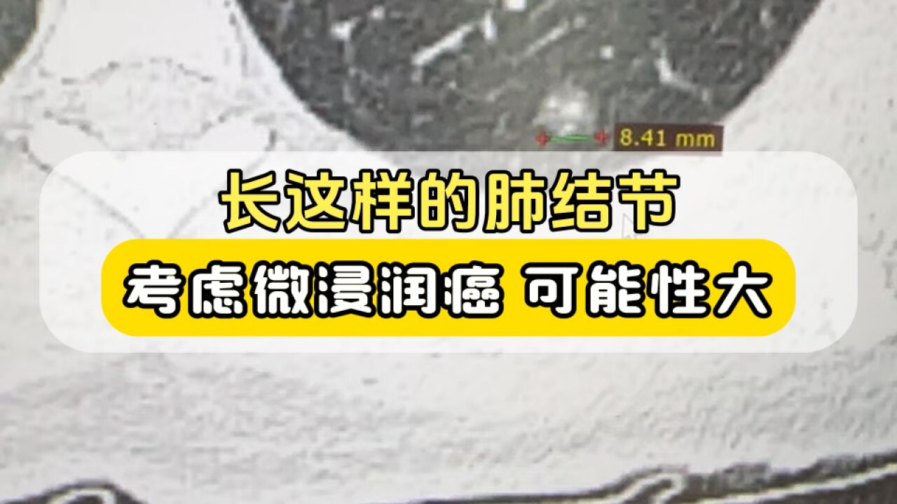 8mm的肺磨玻璃结节,我是如何判断它“微浸润癌”可能性?