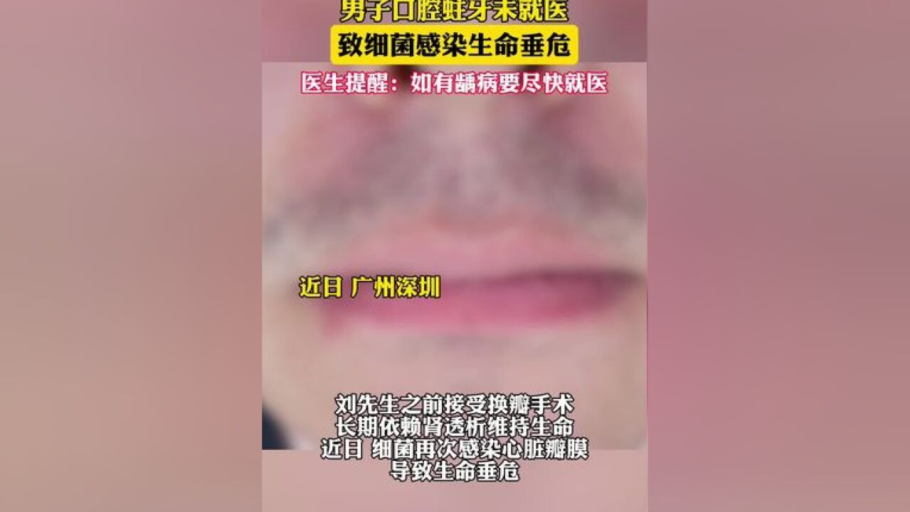 男子口腔蛀牙未就医,致细菌感染生命垂危;医生提醒:如有龋病要尽快就医