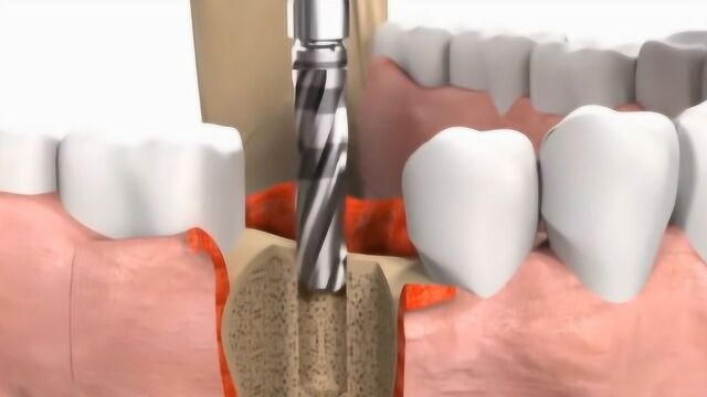 种植牙齿花得钱太多?看看“种植体”的打造过程,看完懂了凭啥贵