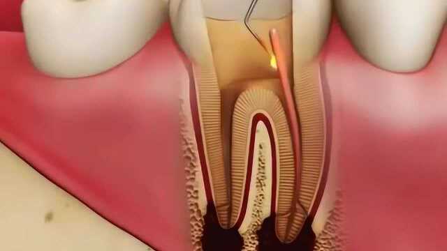 深圳奥瑞口腔带你看一下牙髓坏死根管治疗的过程