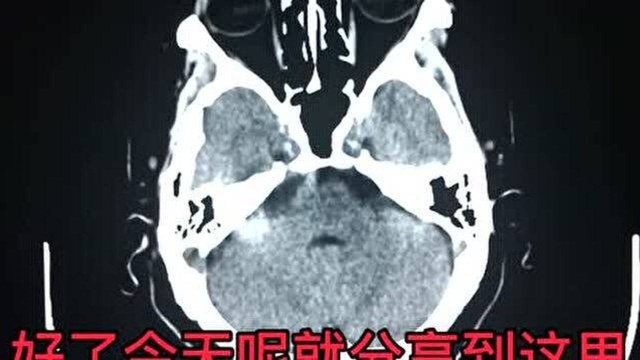 影像初学者该如何看头颅CT,才能做到不漏诊,都有哪些需要观察?