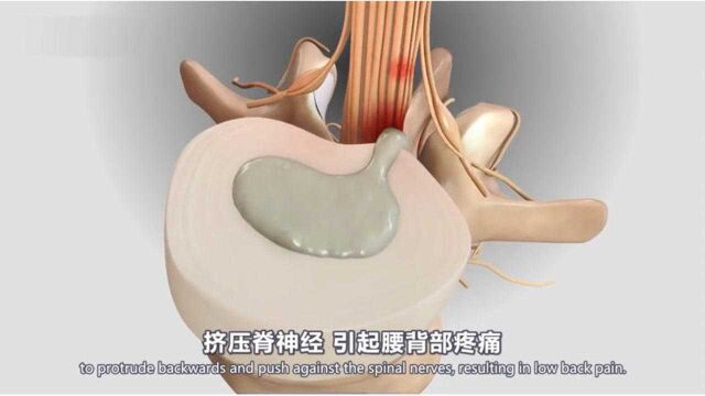 3D动画演示腰背部解剖及腰痛康复训练