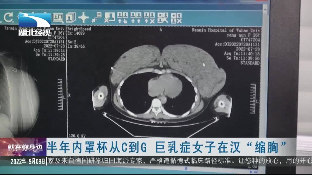 半年内罩杯从C到G 巨乳症女子在汉“缩胸”