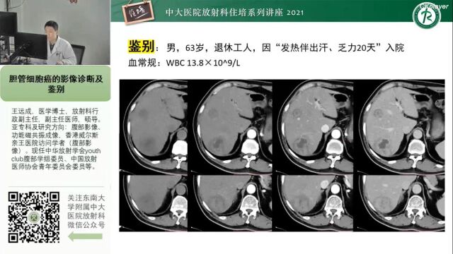 胆管细胞癌的影像诊断及鉴别中大王远成