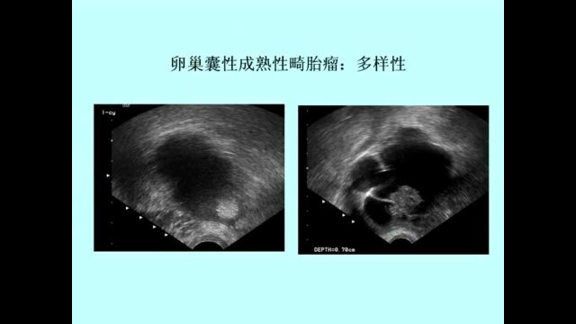 cdfi彩色超声医学考试教学视频第十六至十七章 妇产科辅导