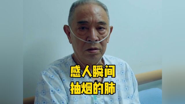 抽烟的危害有多大,看看这位50年烟龄老人的肺.