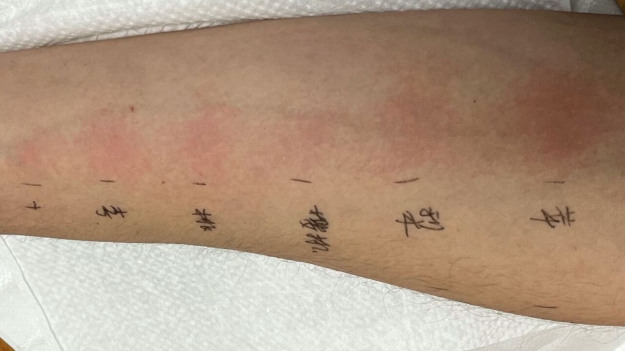 一男子吃新鲜水果就全身发痒,被诊断为“非典型过敏人”